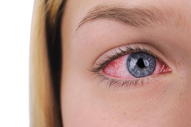 How to Make Your Eyes Look Normal After Using Cannabis- DATOS