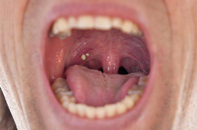 Can tonsils grow back after being removed? – tymoff